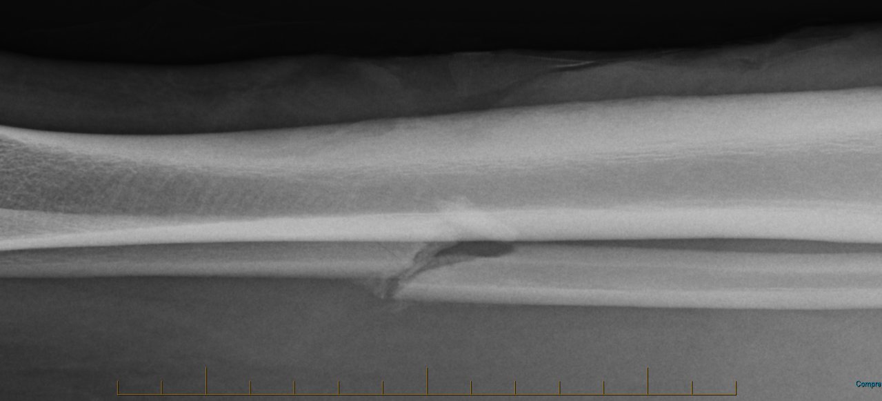 03 tib fib 4.jpg