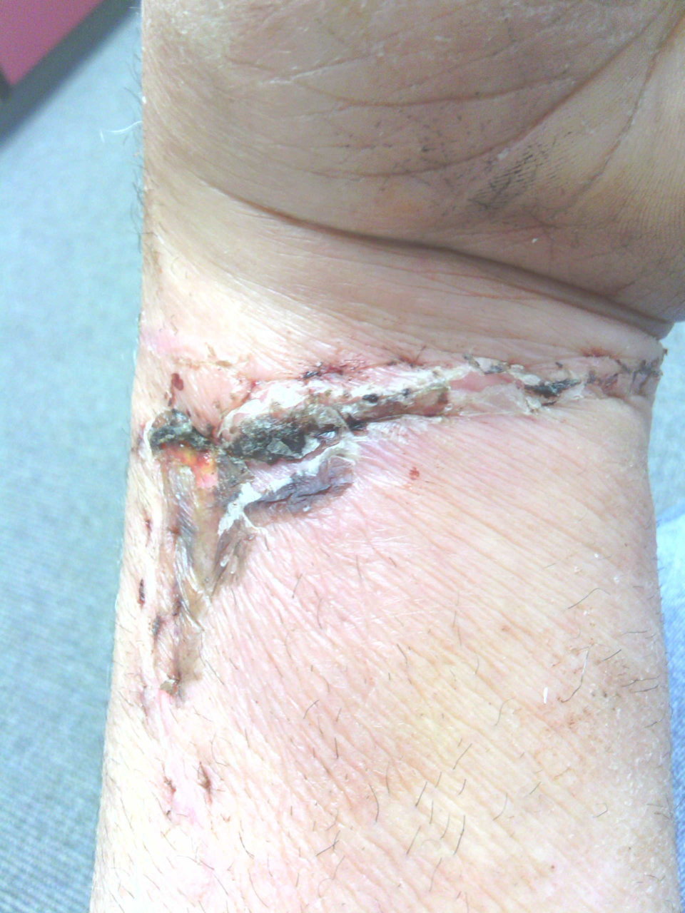 2 weeks after corective surgery.jpg