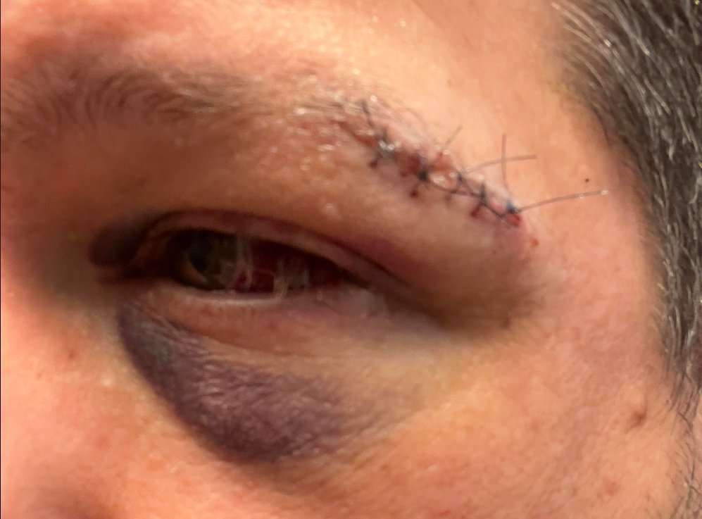 20240223-adamFaceInjury.png