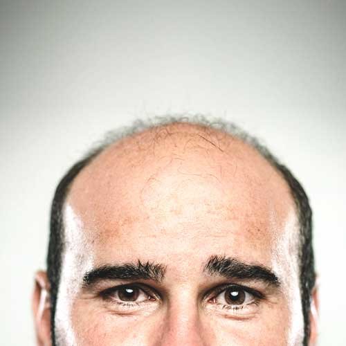 2129-bald_male-500x500-small_widget.jpg