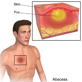 270px-Blausen_0007_Abscess.jpg