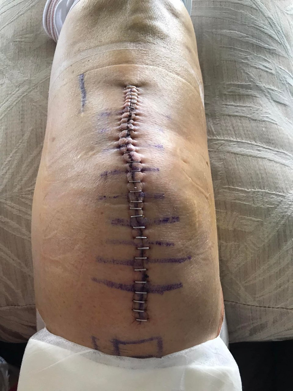 295982530_10159817618019185_6916901730294684958_n Con's knee.jpg