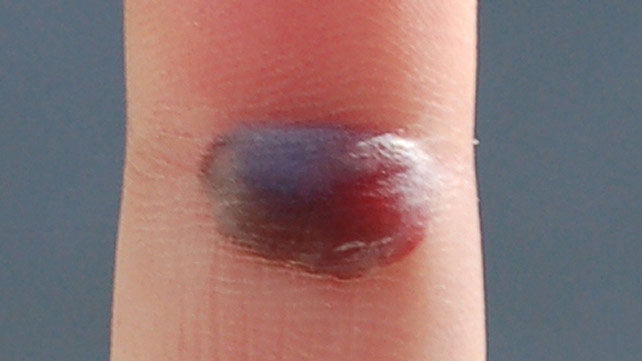 642x361_Slide_1_Blood_Blister.jpg