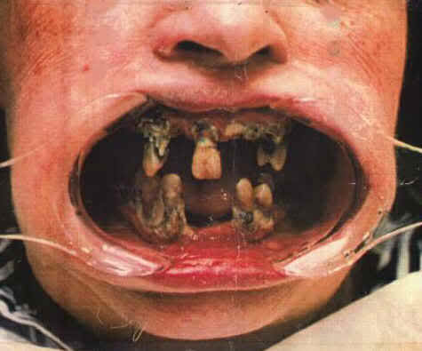 bad-teeth_8751508317e86fe9d74e73dc803c03fd999f9f26.jpg