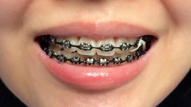 Black-Braces-Color-Pictures.jpg
