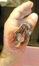 brown-recluse-spider-bite-b.jpg
