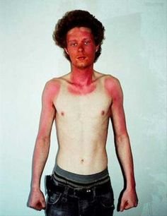 c2526fc5190cecb29ff155fd20aea681--funny-sunburn-shades-of-red.jpg