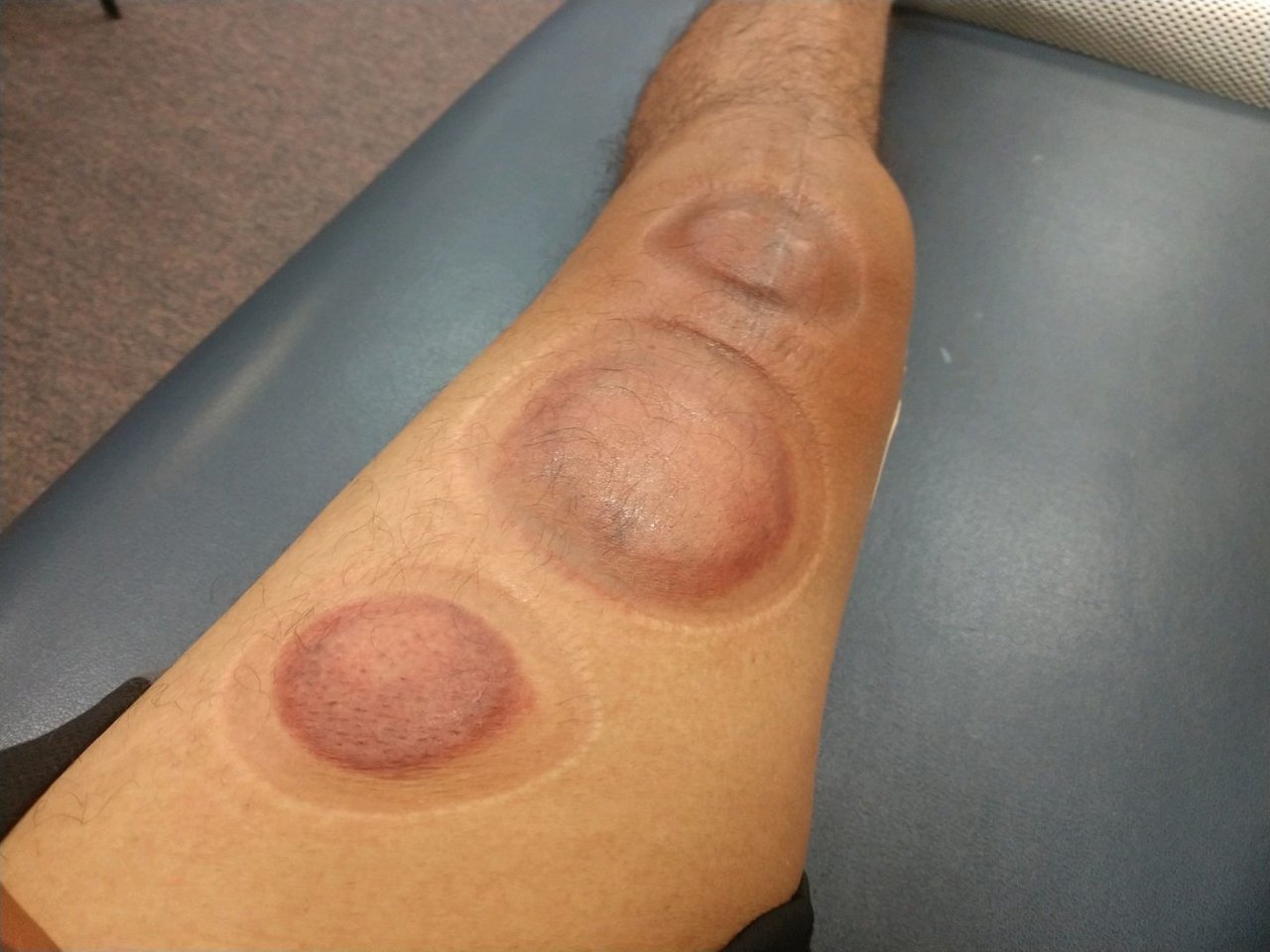 Cupping%202_zps6z32s4rw_5b8b6ca0e6f53490c493e0c9f2d4952b2072bbd6.jpg