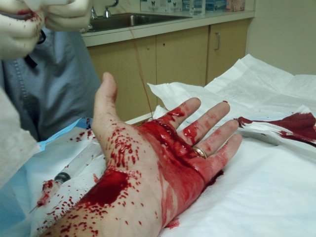 Cut hand.jpg