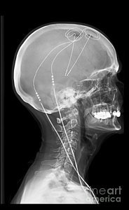 DBS_XRAY.jpg
