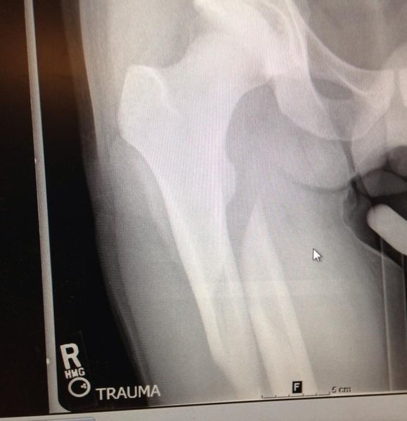 Femur.jpg