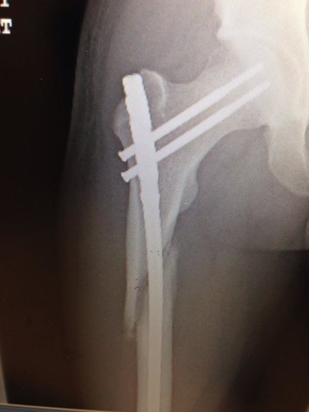 Femur2.jpg