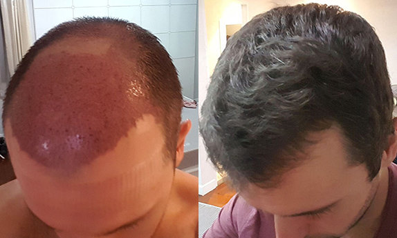 fut-bangkok-transplant.jpg