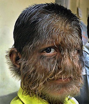 India, hairy boy Prithviraj Patil.jpg