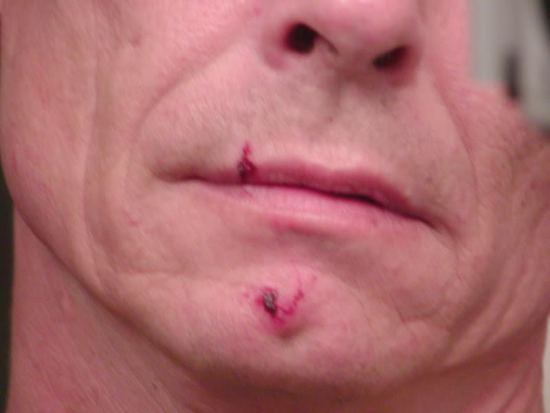 injury01_b66aaa268401b0d030723baf1759c112eb597bb1.jpg