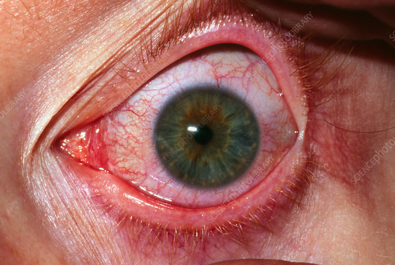 Iritis-1.jpg
