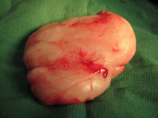 Lipoma.jpg