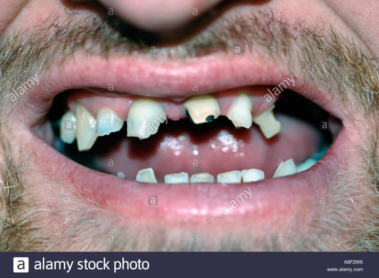 mans-disfigured-teeth-A8F2W6-1.jpg