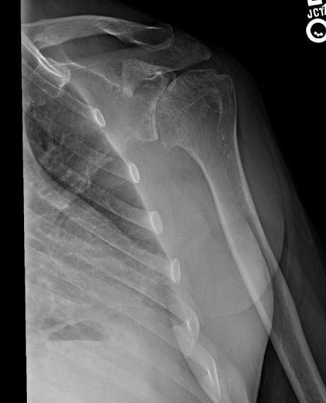 old shoulder.jpg