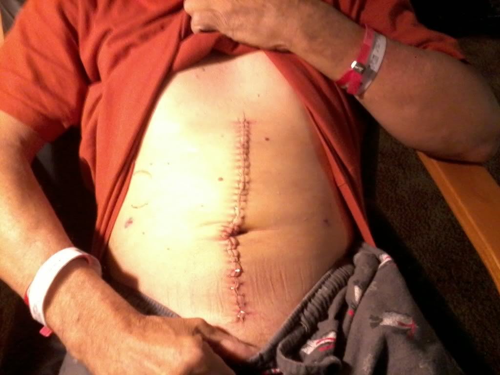 PancreaticAneuryismsurgery_86ef19bc7773dd3a769edc45481ca010bfc3cff7.jpg