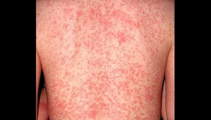 rash.jpg