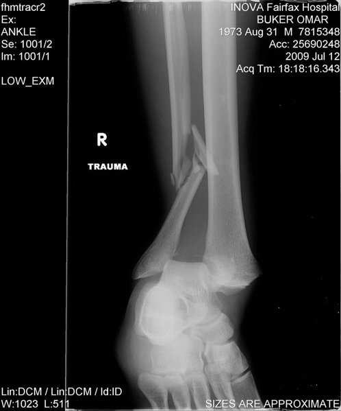 right leg.jpg