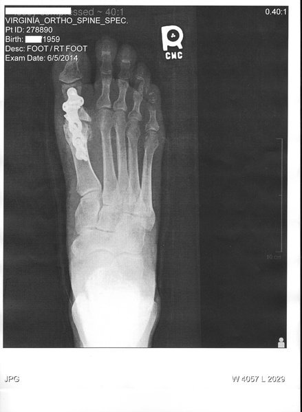 rt foot xray.jpg