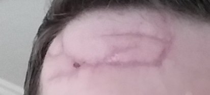 Scar.jpg