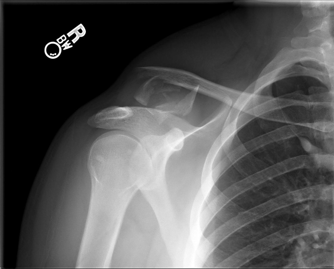 Shoulder1_13fd55d325aed98f35cc25c4c7f9b19fdfeac03d.jpg