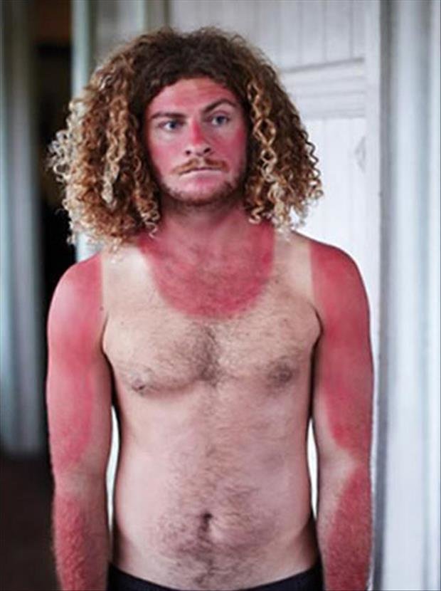 sunburn-pictures-dumpaday-2_zpsf162f2be_efa570f24b978c5aac5b1cce875ffbffc805e751.jpg
