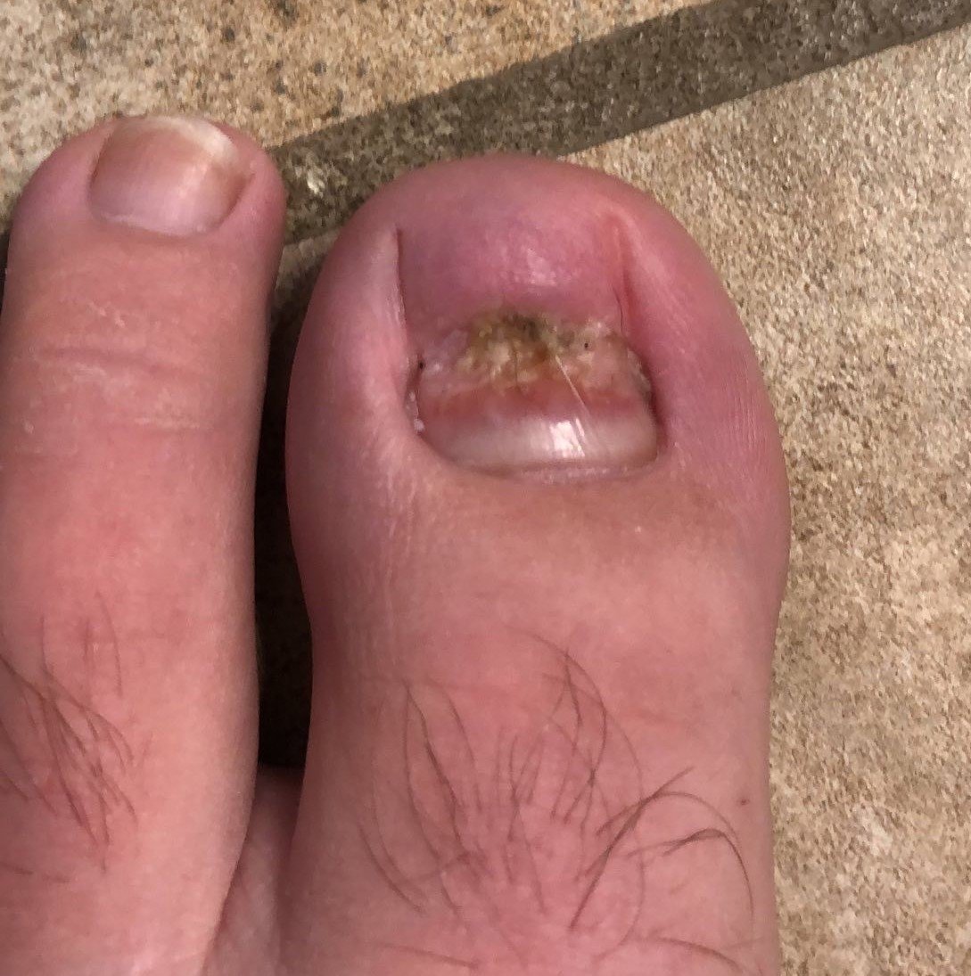 toe.jpg