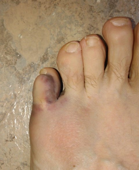toe.jpg