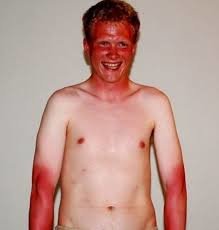 ultimate dome burn.jpg