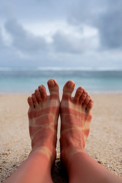 view-woman-s-sunburn-feet-from-wearing-sandals-beach_23-2150282768.jpg