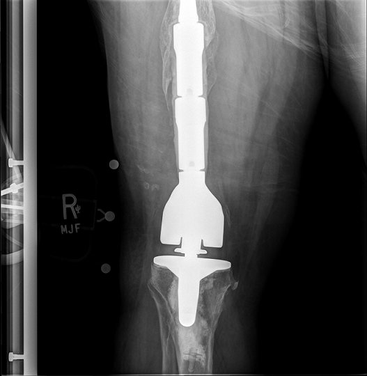 x-ray of implant.jpg