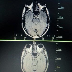 So a cross section of an mri scan makes my brain and eyes look like I am the Millennium Falcon. Sweet