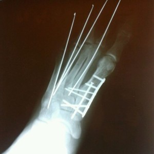 Foot Xray