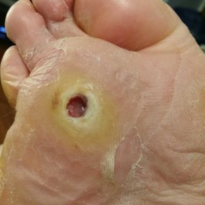 Plantar wart