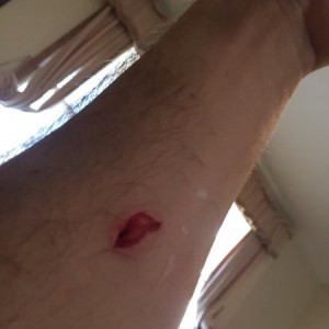 Doh. Razor knife. Sitting at the urgent care place now.