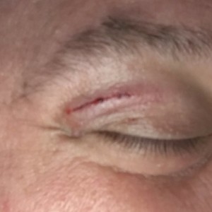 Pitchfork to the eyelid.