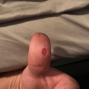 Burnt Thumb