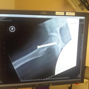 Rachels hip surgery x-ray