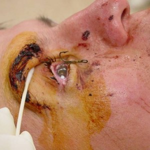 Fish Hook in Eye - sunglasses needed