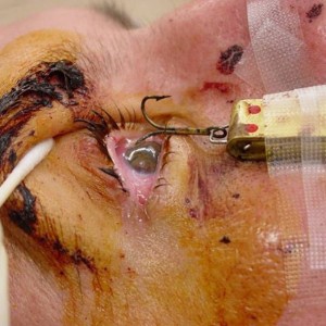 Fish Hook in Eye - sunglasses needed