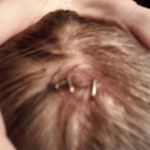 3 staples and a concussion