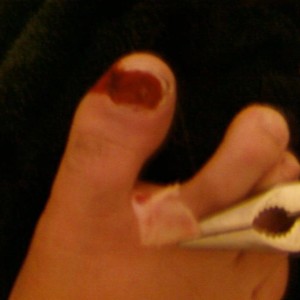 Pulled off toe nail