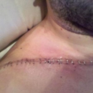 buddy crash his raptor first day.3 broken ribs and broke his collar bone in