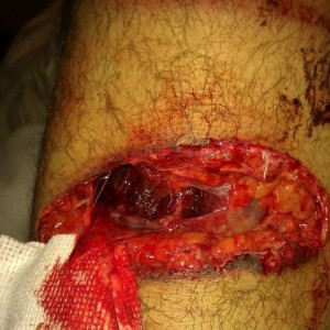 This is what happens when a tacoma falls on your leg ....