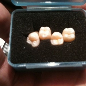 My pain in the ass wisdom teeth