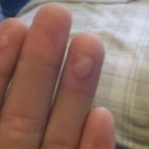 My fingers after grabbing my tire when it fell off.